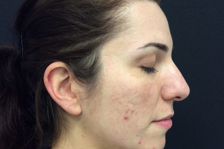 12. pre laser treatment front - acne scarring treatment perth