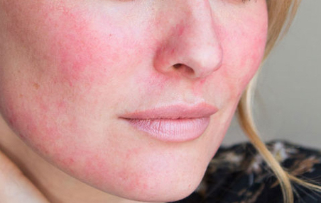 Roseca treatment perth - rosacea treatment cottesloe