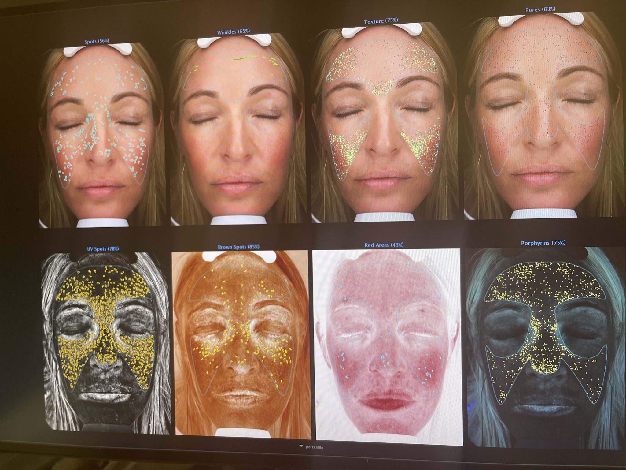 VISIA Skin Analysis Perth - Azure Medical